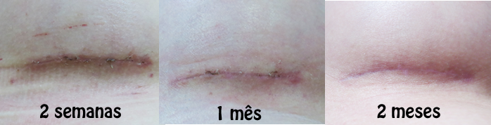 antes e depois cicatriz prótese de silicone