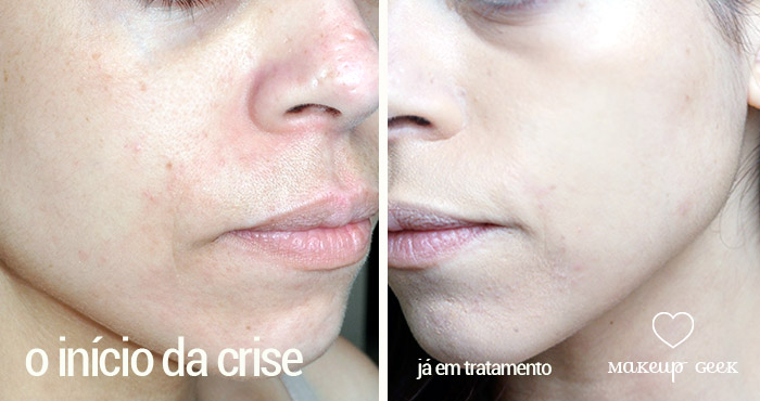 Dermatite Tratamento  Geek