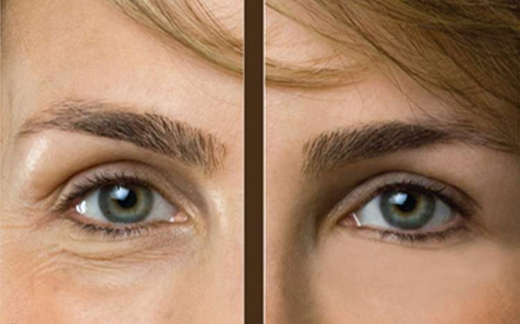 Antes e depois de eliminar olheiras e bolsas abaixo dos olhos