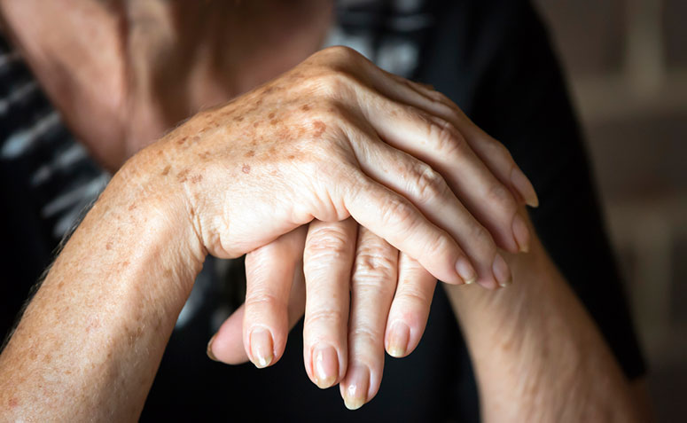 Artrose: médico fala das causas, sintomas, prevenção e tratamentos 1