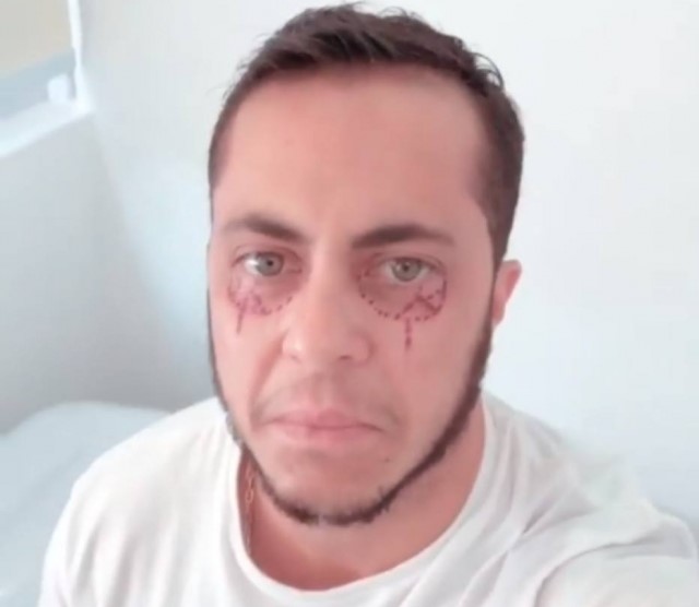Thammy antes de se submeter à tatuagem para disfarçar olheiras - Foto: Reprodução, Instagram